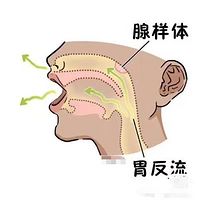 过敏性鼻炎扁桃体肿大腺样体肥大