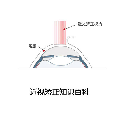 近视矫正知识百科