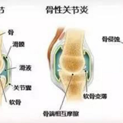 骨性 关节炎